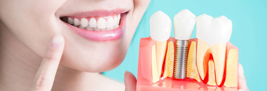 Remplacer toutes les dents avec implants dentaires